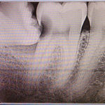 Do Wisdom Teeth Need to be Extracted? Ask an Apex Oral Surgeon
