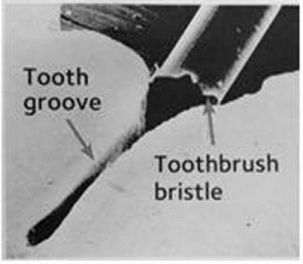 tooth-groove