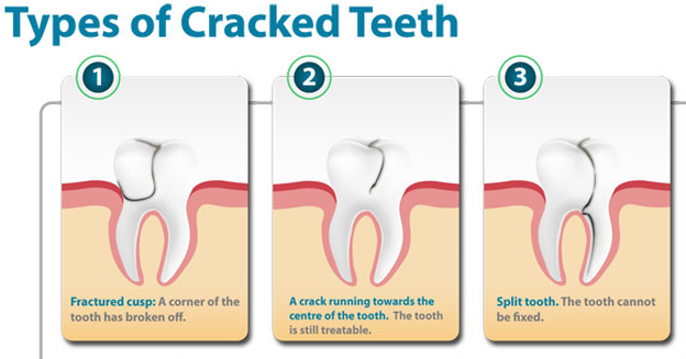 types-cracked-teeth
