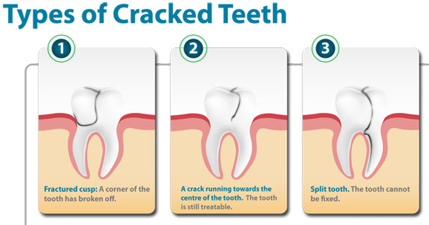 Broken molar on sale