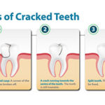 Apex Oral Surgeon Explains Why You Shouldn't Ignore Cracked Teeth
