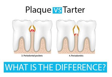 Plaque vs. tartar: Differences, formation, and more